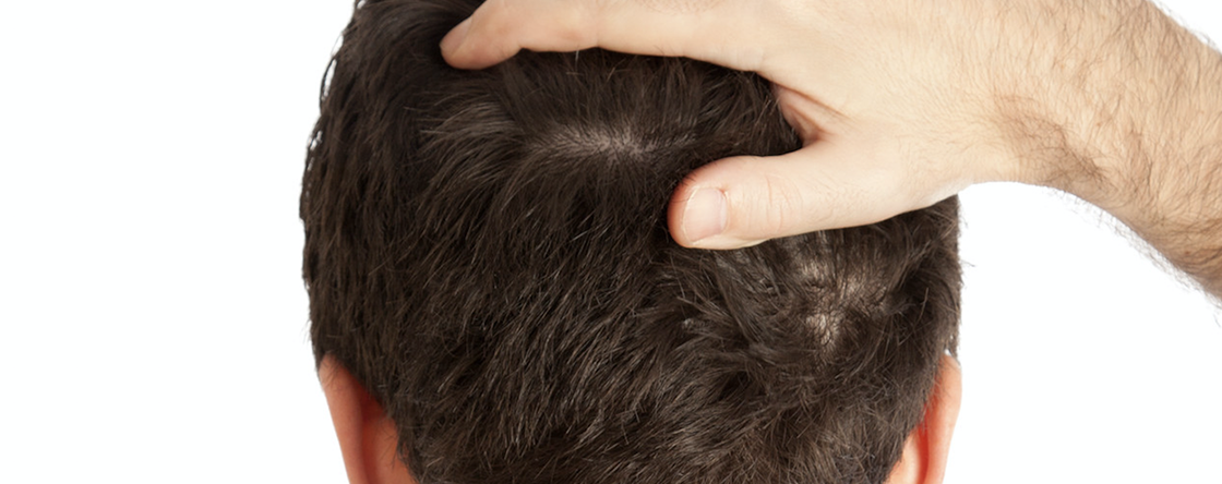 Che shampoo usare se soffri di dermatite seborroica