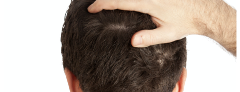 Che shampoo usare se soffri di dermatite seborroica