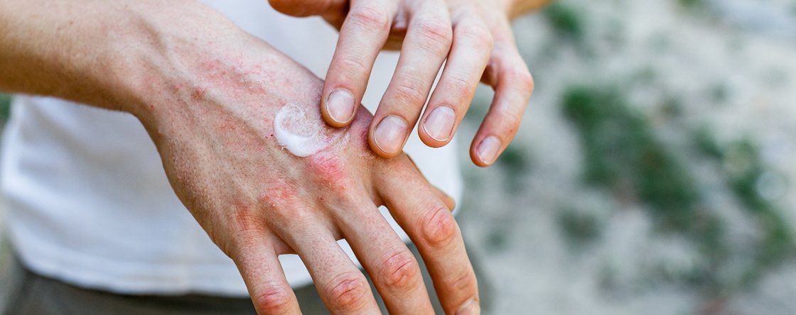 Quanto durano i geloni alle mani?