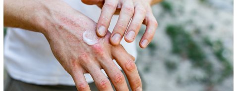 Quanto durano i geloni alle mani?