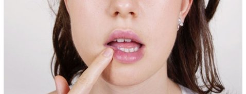 Come eliminare herpes labiale: i rimedi naturali Come eliminare herpes labiale: i rimedi naturali